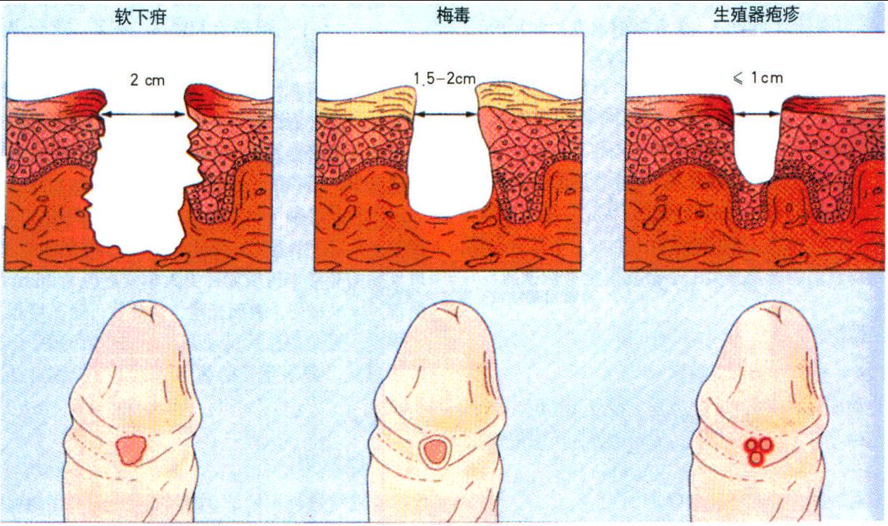 軟下疳